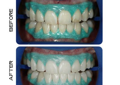Laser assisted Teeth whitening by Dentistry by design , Bryanston